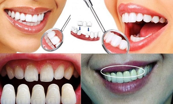 Bọc răng sứ có thể dẫn đến một số biến chứng như hôi miệng 